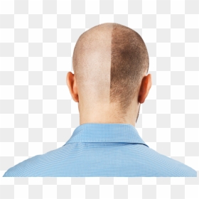 Hair Loss, HD Png Download - hairstyle transparent male png