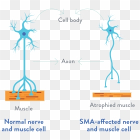 Motor Neuron Spinal Muscular Atrophy, HD Png Download - neurons png