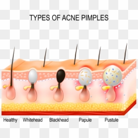 Blackhead Pustule, HD Png Download - pimple png