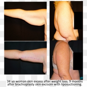 Photo Caption, HD Png Download - muscle arms png