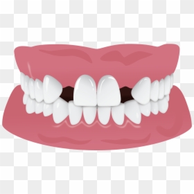 Ipr Black Triangles Results, HD Png Download - tooth png