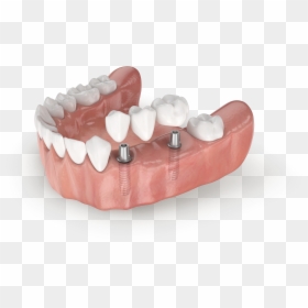 Náhrada Zubu, HD Png Download - tooth png