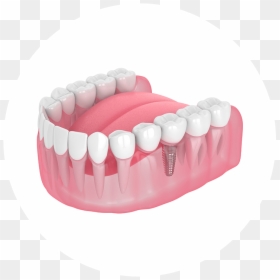 Dental Implant, HD Png Download - tooth png