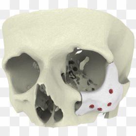 Maxillofacial Surgery Trauma 3d Printing, HD Png Download - bone.png