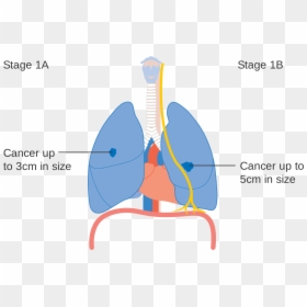 Lung Cancer Stages Diagram, HD Png Download - lung cancer ribbon png