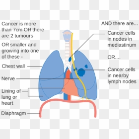 Clip Art Lung Cancer Pictures - Lung Cancer Diagram, HD Png Download - lung cancer ribbon png