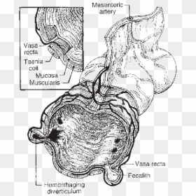 Cross Section Of A Diverticulum, HD Png Download - colon png
