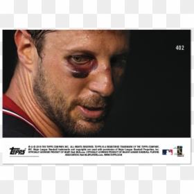 Max Scherzer Broken Nose, HD Png Download - ethan klein png