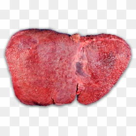 Cirrhosis Of The Fibronostics - Fulminant Hepatic Failure Fhf, HD Png Download - failure png