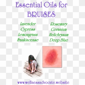 Picture - Essential Oil For Bruise, HD Png Download - bruises png