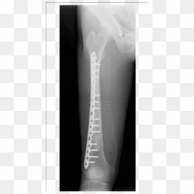 Postoperative Radiography After The Femur Reconstruction - X-ray, HD Png Download - xray png