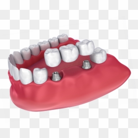 Illustration Of An Implant-supported Bridge - Dental Hd Images Png, Transparent Png - bridges png