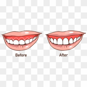 Gum Mouth Clipart - Do Some People Smile With Gums, HD Png Download - mouth clipart png