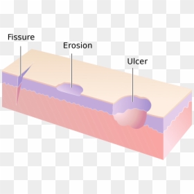 Erosion And Ulcer Difference, HD Png Download - cracks texture png