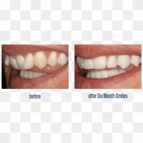 Front Teeth Go Inwards, HD Png Download - teeth png