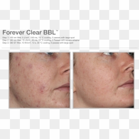Forever Clear Bbl Before And After, HD Png Download - face scar png