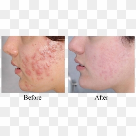 Clinical Pro Heal Serum Reviews, HD Png Download - face scar png