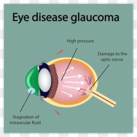 What Is Glaucoma - Glaucoma Diseases, HD Png Download - eye drops png