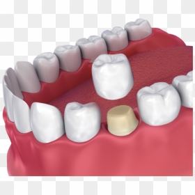 Dental Crown, HD Png Download - teeth grill png