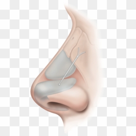 Latera - Latera Nasal Implant, HD Png Download - nose.png