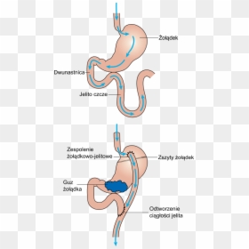 Diagram Showing Before And After Stomach Bypass Surgery - Antrum Żołądka, HD Png Download - before and after png