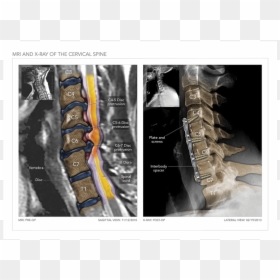 Mri And X-ray Of The Cervical Spine - Medical Imaging, HD Png Download - spine png