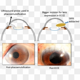 Cataract Surgery - Types Of Cataract Surgery, HD Png Download - eye lens png