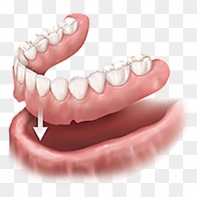 Implant Supported Dentures, HD Png Download - dentures png