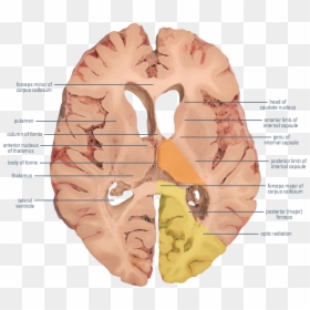 Transparent Corpus Callosum Clipart - Optic Radiation Horizontal Section, HD Png Download - minior png