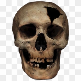 #freetoedit #skull #cracked #stickerart - Blunt Force Trauma Skeleton, HD Png Download - cracked skull png