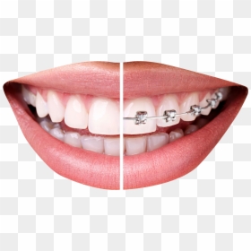Thumbs Up Png Transparent Image - Teeth Braces Png, Png Download - jaw png