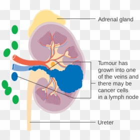 Kidney Cancer Surgery - Kidney Cancer Stage Symptom, HD Png Download - kidneys png