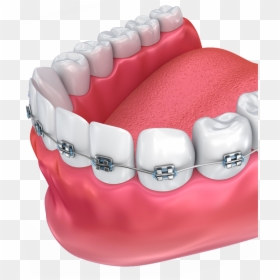 Haltom Orthodontics - Teeth Braces Png, Transparent Png - brace png