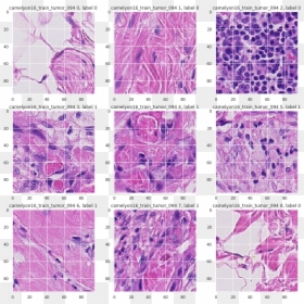 Histopathologic Cancer Detection, HD Png Download - tumor png