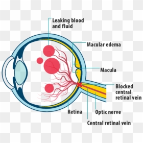 Picture Of Effects Of Mefcrvo On The Eye, Showing Leaking - Central Retinal Vein Occlusion Diagram, HD Png Download - eye veins png