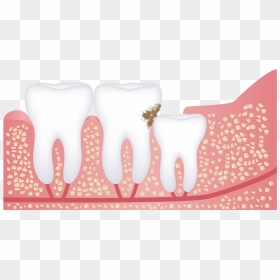 Wisdom Tooth Tooth Decay Transparent E1561524853641 - My Wisdom Tooth Hurting, HD Png Download - tooth png