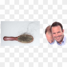 Transparent Loss - Hair Loss Treatment, HD Png Download - loss.png