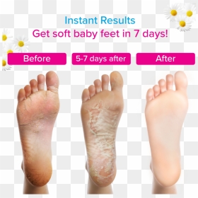 Transparent Baby Feet Png - Peeling Foot Mask Before And After, Png Download - feet png