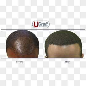 This Patient Benefited From 1400 Grafts Safely Extracted - Buzz Cut, HD Png Download - hair texture png