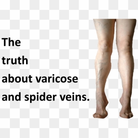 Spider Veins Photos - Tights, HD Png Download - veins png