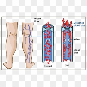 The Danger Of Dvt - Deep Vein Thrombosis Meaning, HD Png Download - veins png