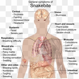 Infectious Mononucleosis, HD Png Download - bite mark png