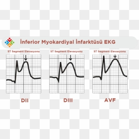 St Elevation Mi, HD Png Download - ekg png