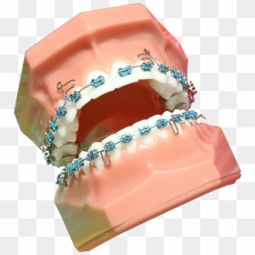 Transparent Braces Png - Rodzaje Aparatów Ortodontycznych Stałych, Png Download - braces png