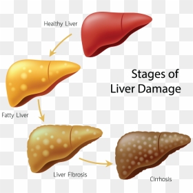 Transparent Fatty Liver Clipart - Damage Liver, HD Png Download - liver png