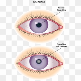 Difference Between Cataract And Corneal Opacity, HD Png Download - eyes lens png