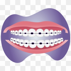 Metal Braces On Teeth - Tongue, HD Png Download - buck teeth png