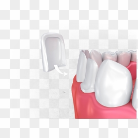 Porcelain Veneers - Dental Veneers Png, Transparent Png - buck teeth png