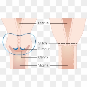Trachelectomy 中文, HD Png Download - vagina png