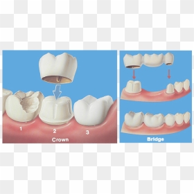 Crown Bridge Hobe Sound Dentist - Dental Crown And Bridge, HD Png Download - dentist png